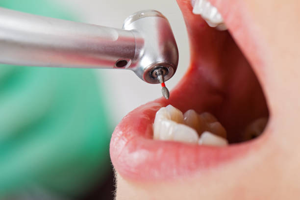 Best Emergency Broken Tooth Repair in Danville, CA